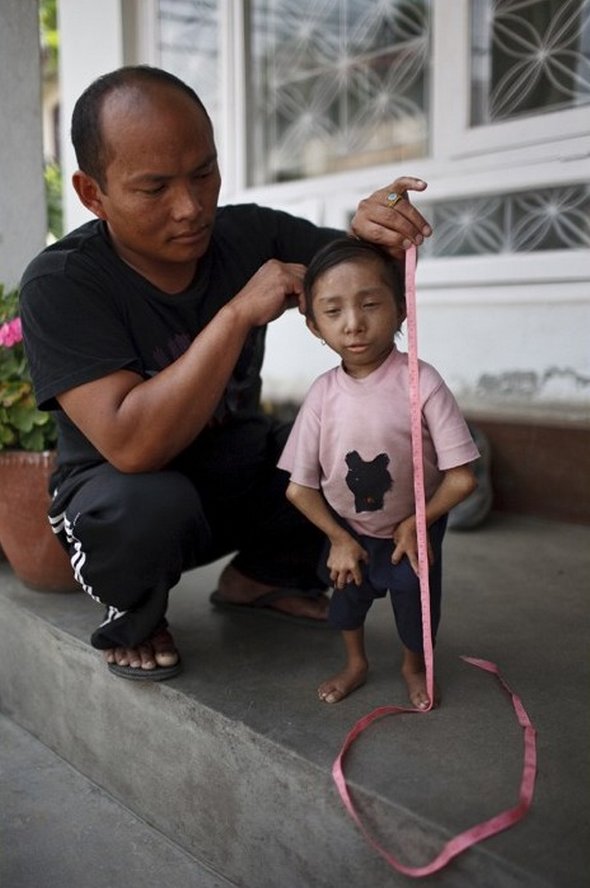 Smallest Man In The World From Nepal