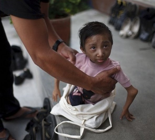 Smallest Man In The World From Nepal