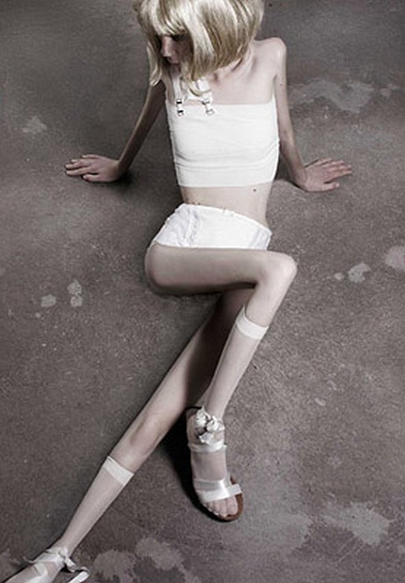 anorexic models 01 in Anorexic Models don’t Always Look Like Models
