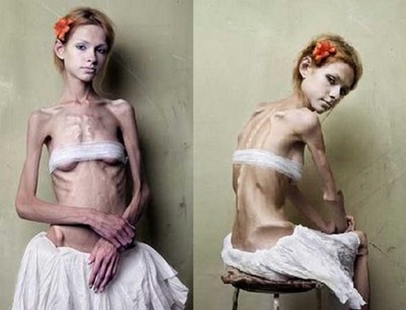 Τα πρότυπα Anorexic όχι πάντα μοιάζουν με τα πρότυπα
