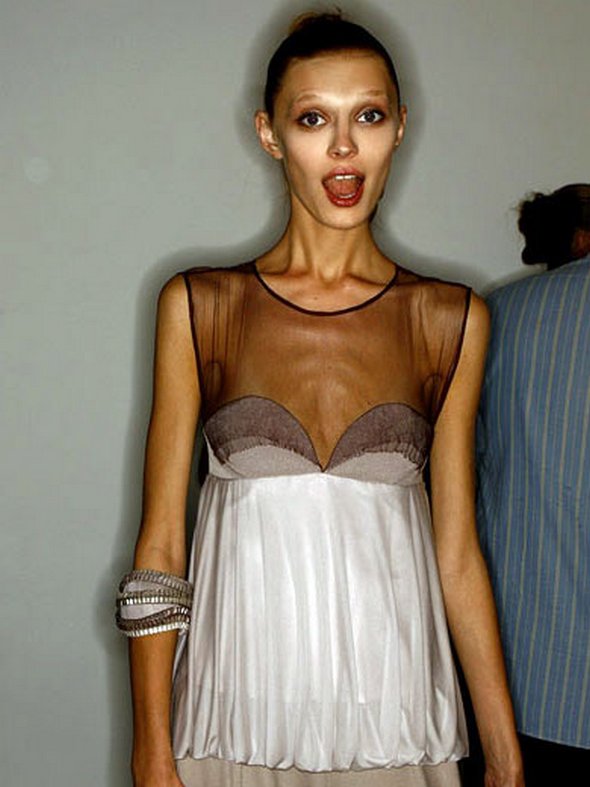 Anorexic Model 78