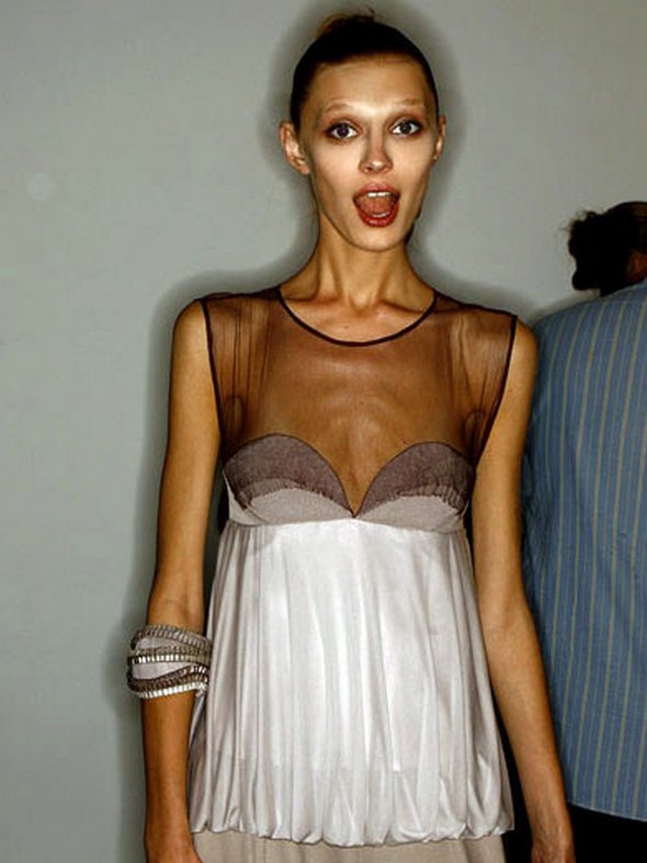 Anorexic Models don’t Always Look Like Models