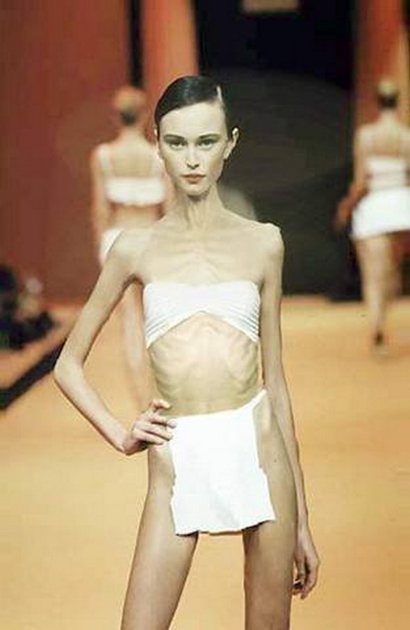 Anorexic Models don’t Always Look Like Models