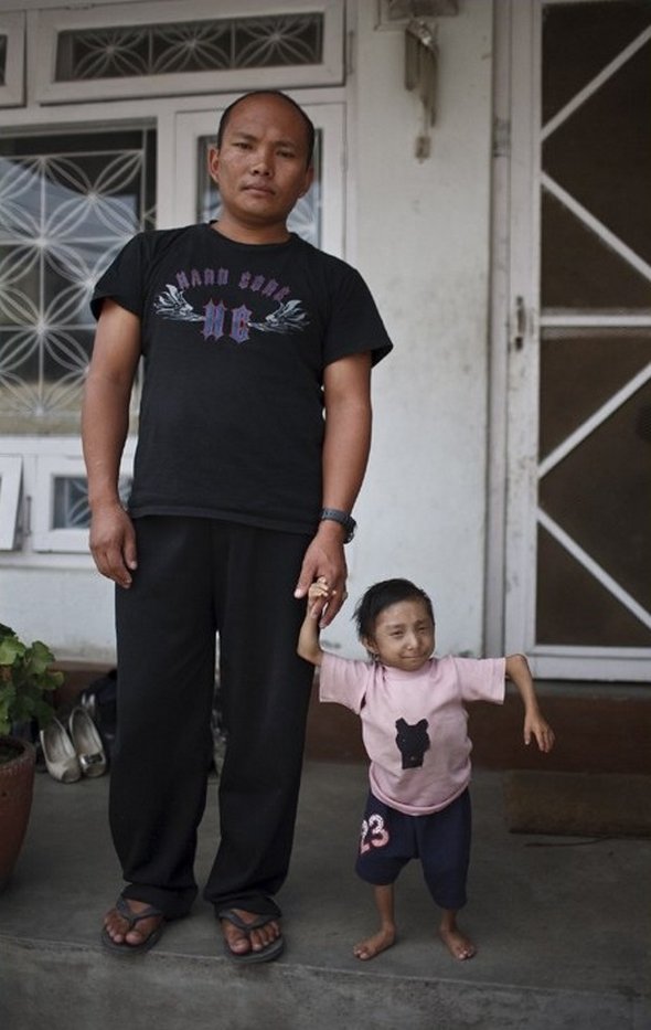 Smallest Man In The World From Nepal