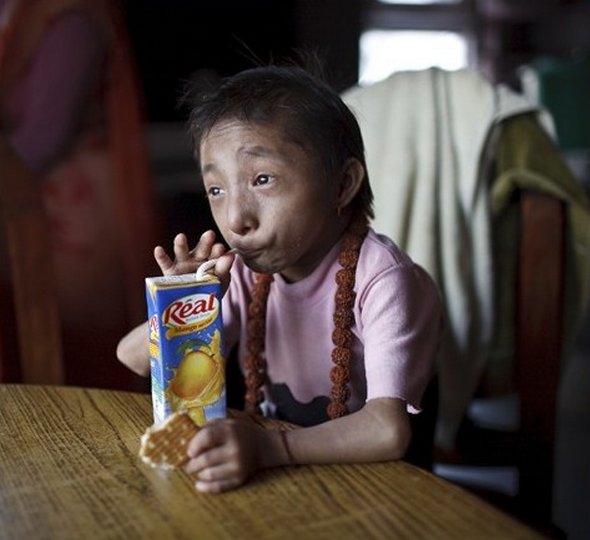 Smallest Man In The World From Nepal