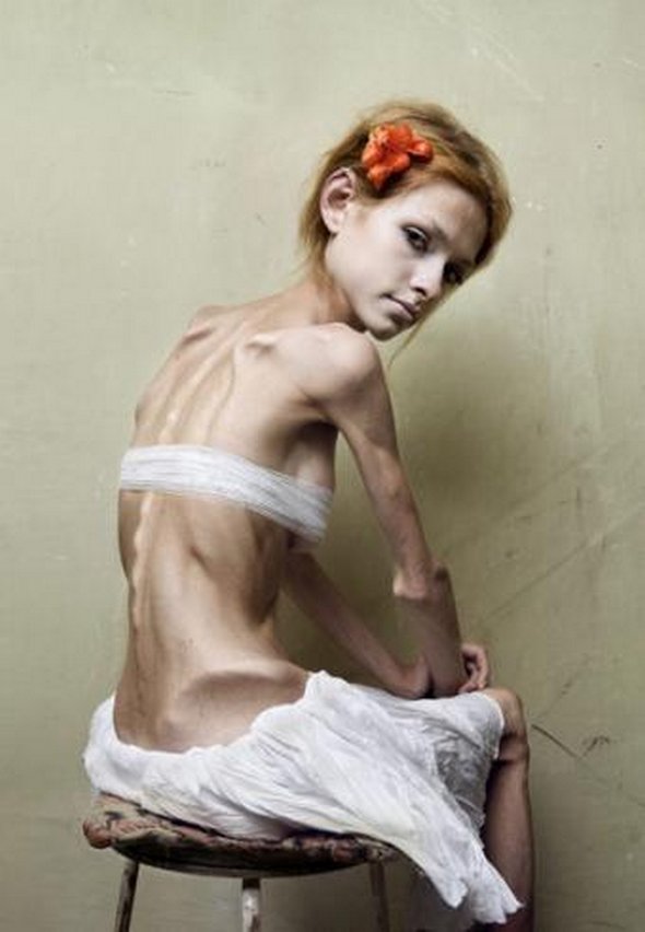 anorexic models 09 in Anorexic Models don’t Always Look Like Models